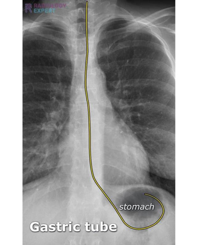 chest-x-ray-icu